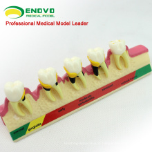 Super Septembre VENDRE 12585 Modèle de Classification Parodontal 2x Taille de la Vie Dents Maladie